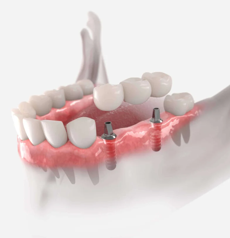 Dental Crown Types